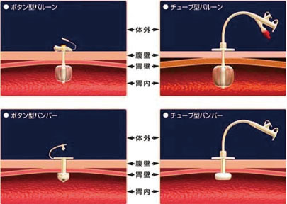 胃内固定版